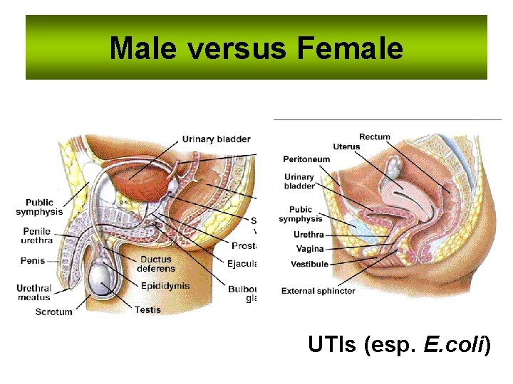 Male versus Female UTIs (esp. E. coli) 