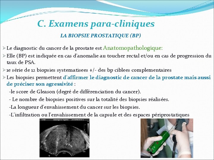 C. Examens para-cliniques LA BIOPSIE PROSTATIQUE (BP) Le diagnostic du cancer de la prostate C. Examens para-cliniques LA BIOPSIE PROSTATIQUE (BP) Le diagnostic du cancer de la prostate