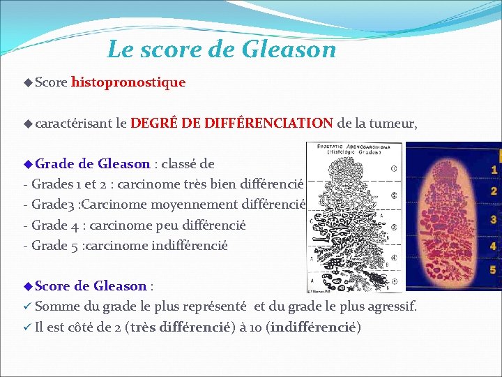 Le score de Gleason Score histopronostique caractérisant le DEGRÉ DE DIFFÉRENCIATION de la tumeur, Le score de Gleason Score histopronostique caractérisant le DEGRÉ DE DIFFÉRENCIATION de la tumeur,