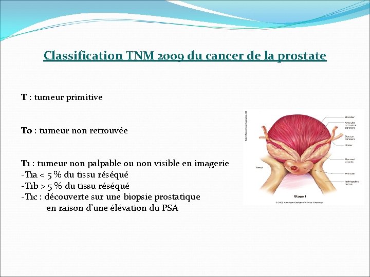 Classification TNM 2009 du cancer de la prostate T : tumeur primitive T 0 Classification TNM 2009 du cancer de la prostate T : tumeur primitive T 0