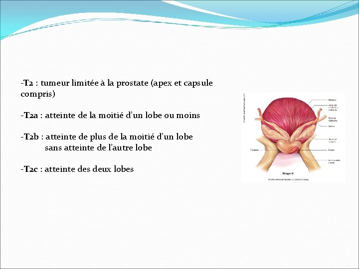 -T 2 : tumeur limitée à la prostate (apex et capsule compris) -T 2 -T 2 : tumeur limitée à la prostate (apex et capsule compris) -T 2