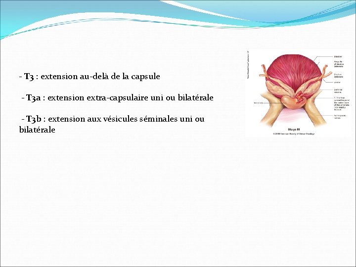 - T 3 : extension au-delà de la capsule - T 3 a : - T 3 : extension au-delà de la capsule - T 3 a :