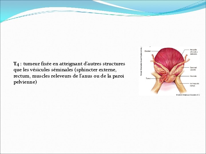 T 4 : tumeur fixée en atteignant d’autres structures que les vésicules séminales (sphincter T 4 : tumeur fixée en atteignant d’autres structures que les vésicules séminales (sphincter