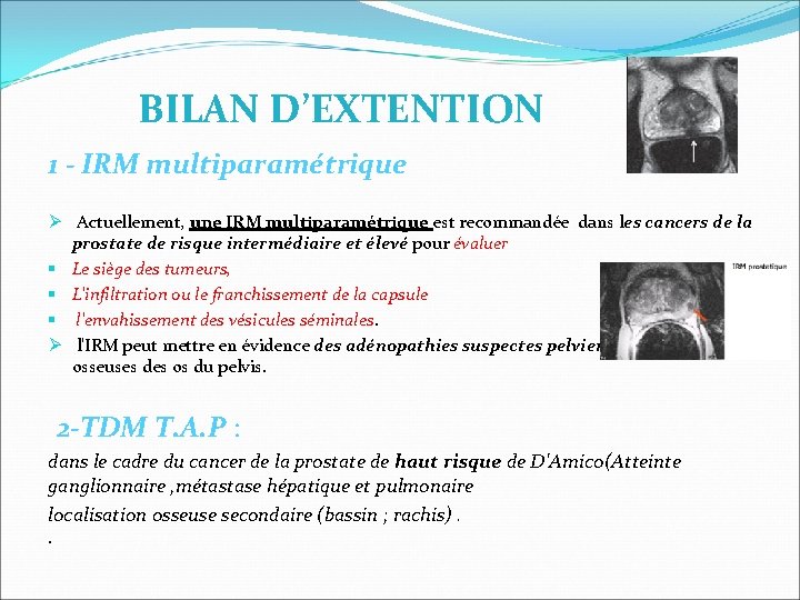 BILAN D’EXTENTION 1 - IRM multiparamétrique Actuellement, une IRM multiparamétrique est recommandée dans les BILAN D’EXTENTION 1 - IRM multiparamétrique Actuellement, une IRM multiparamétrique est recommandée dans les