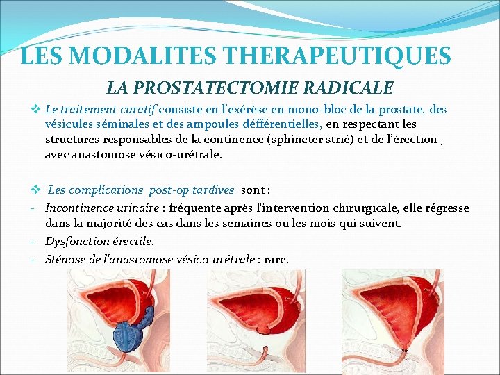 prostatitis antibiotics of choice instalatii pentru prostatita