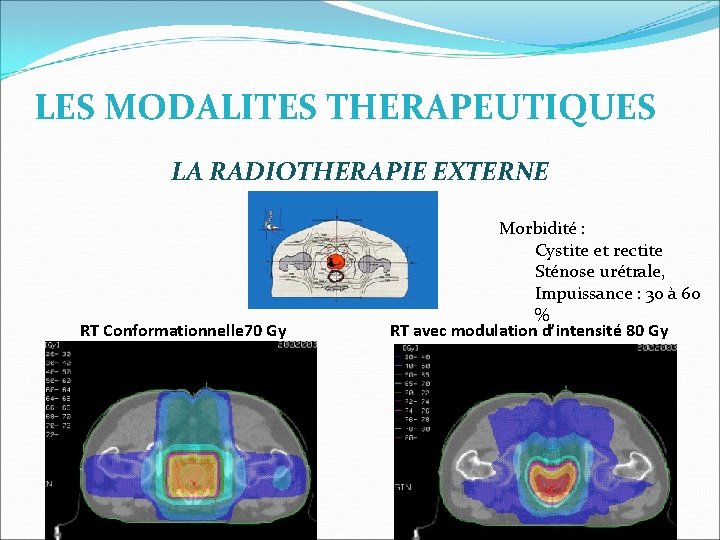 LES MODALITES THERAPEUTIQUES LA RADIOTHERAPIE EXTERNE RT Conformationnelle 70 Gy Morbidité : Cystite et LES MODALITES THERAPEUTIQUES LA RADIOTHERAPIE EXTERNE RT Conformationnelle 70 Gy Morbidité : Cystite et