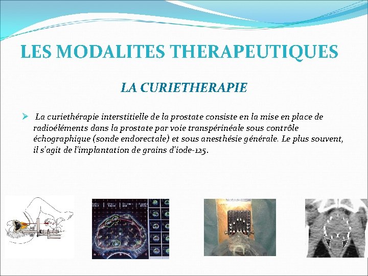 LES MODALITES THERAPEUTIQUES LA CURIETHERAPIE La curiethérapie interstitielle de la prostate consiste en la LES MODALITES THERAPEUTIQUES LA CURIETHERAPIE La curiethérapie interstitielle de la prostate consiste en la