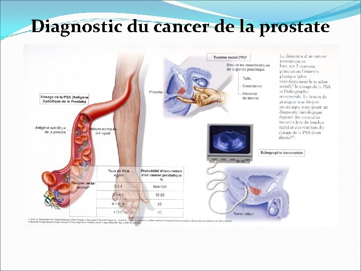 Diagnostic du cancer de la prostate Diagnostic du cancer de la prostate