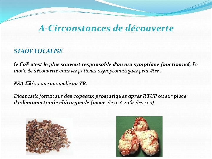 A-Circonstances de découverte STADE LOCALISE: le Ca. P n’est le plus souvent responsable d’aucun A-Circonstances de découverte STADE LOCALISE: le Ca. P n’est le plus souvent responsable d’aucun
