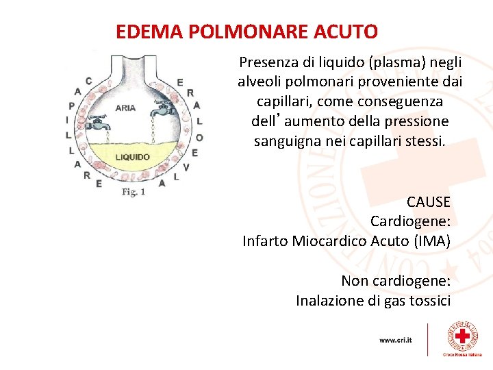 EDEMA POLMONARE ACUTO Presenza di liquido (plasma) negli alveoli polmonari proveniente dai capillari, come