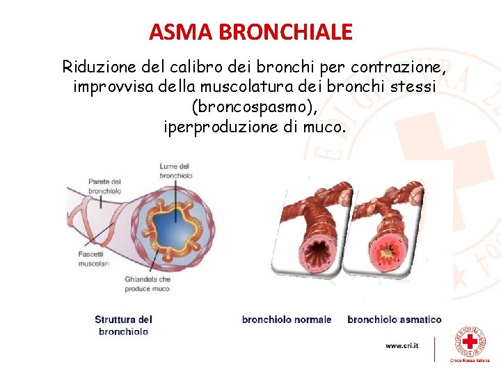 ASMA BRONCHIALE Riduzione del calibro dei bronchi per contrazione, improvvisa della muscolatura dei bronchi