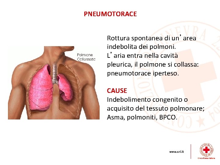 PNEUMOTORACE Rottura spontanea di un’area indebolita dei polmoni. L’aria entra nella cavità pleurica, il