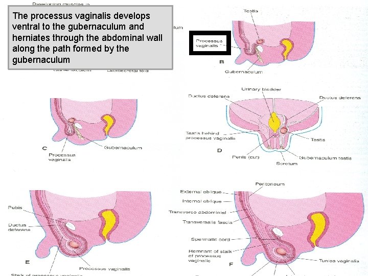 The processus vaginalis develops ventral to the gubernaculum and herniates through the abdominal wall