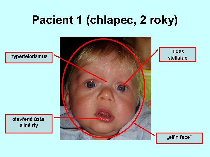 Pacient 1 (chlapec, 2 roky) hypertelorismus irides stellatae otevřená ústa, silné rty „elfin face“