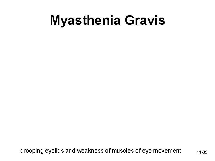 Myasthenia Gravis drooping eyelids and weakness of muscles of eye movement 11 -82 