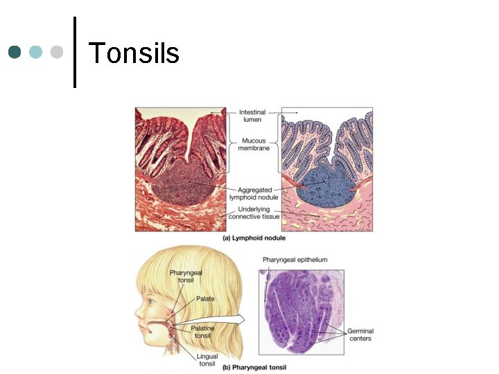 Tonsils 