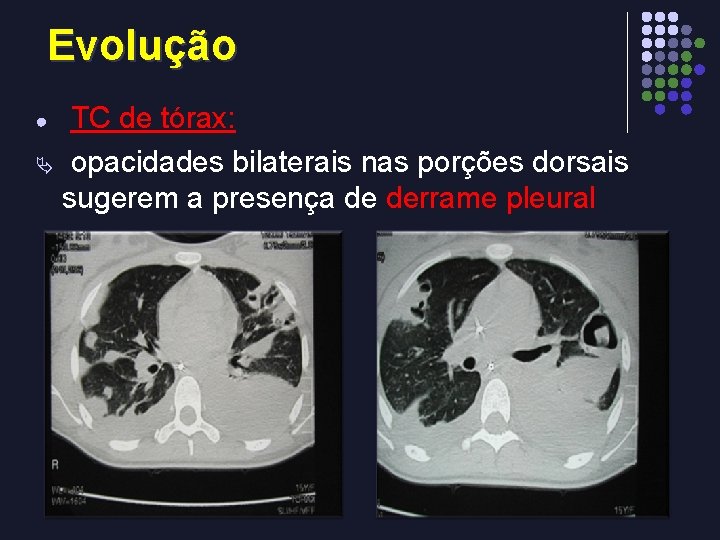 Evolução TC de tórax: Ä opacidades bilaterais nas porções dorsais sugerem a presença de