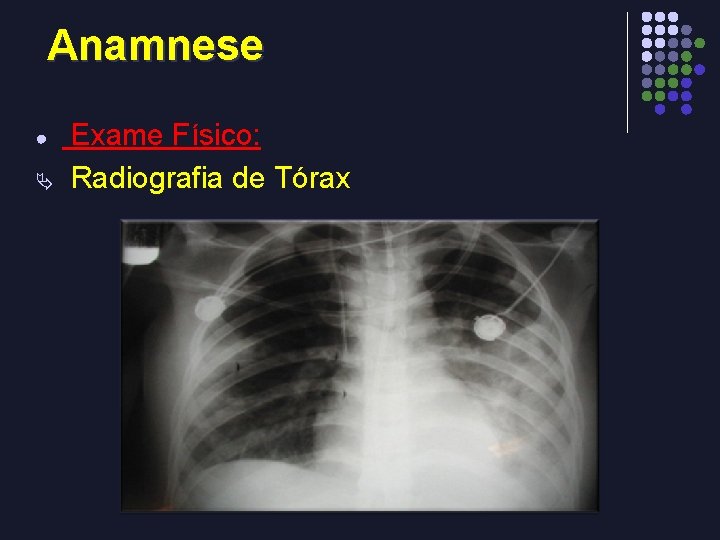 Anamnese Exame Físico: Ä Radiografia de Tórax ● 