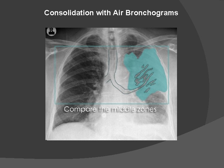 Consolidation with Air Bronchograms 