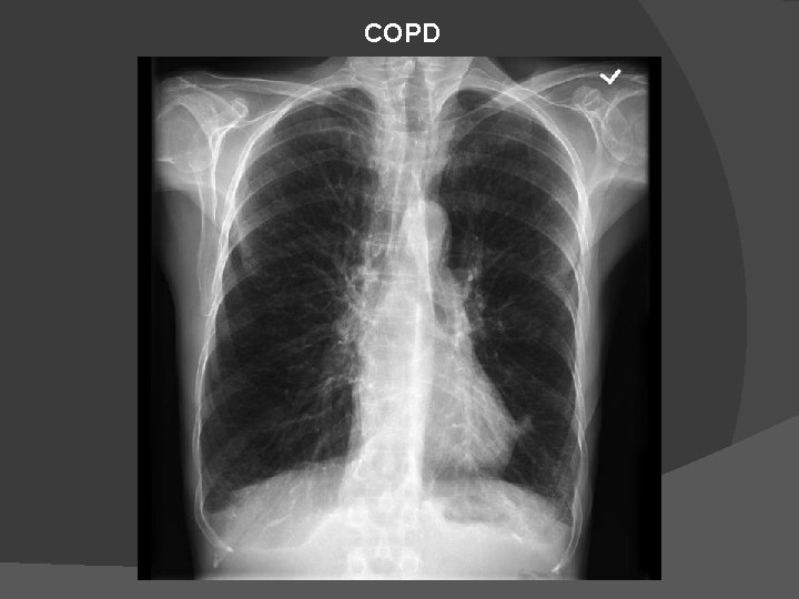 COPD 