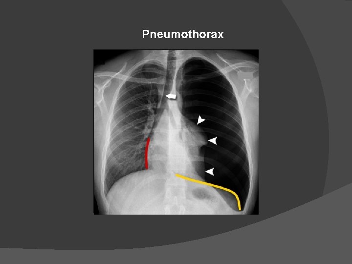 Pneumothorax 