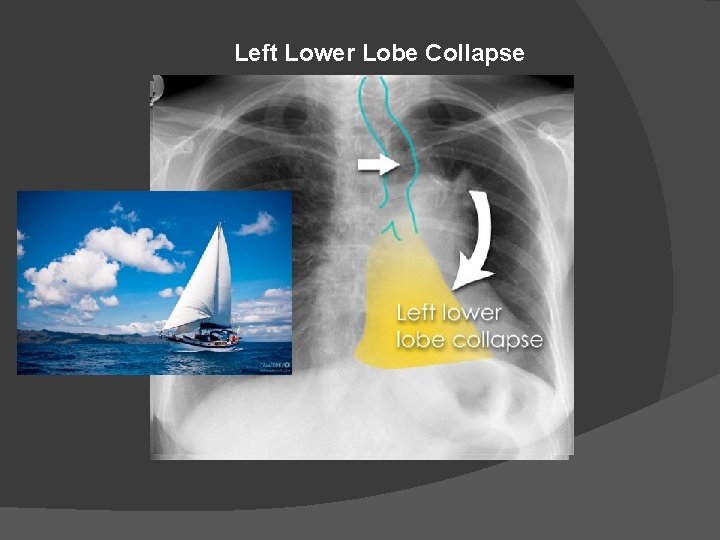 Left Lower Lobe Collapse 
