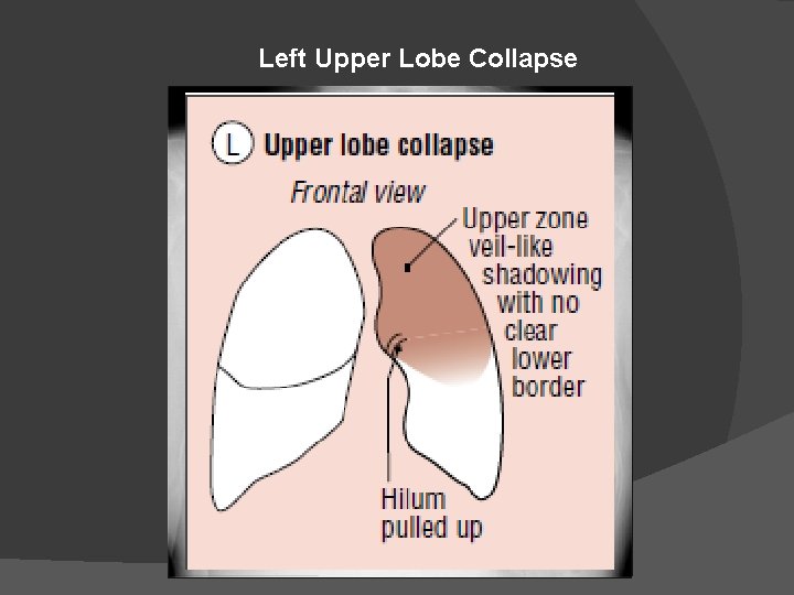 Left Upper Lobe Collapse 