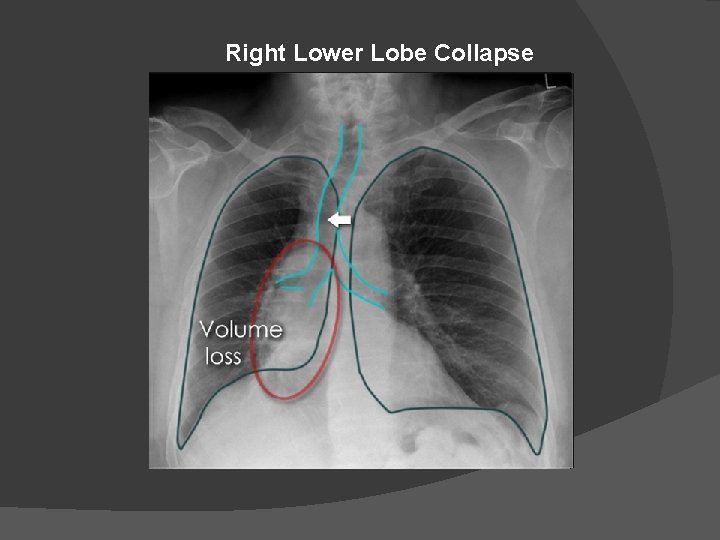 Right Lower Lobe Collapse 