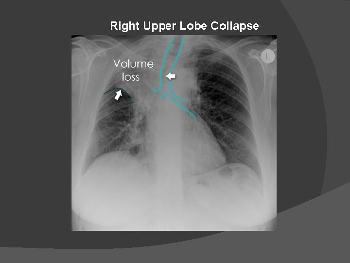 Right Upper Lobe Collapse 