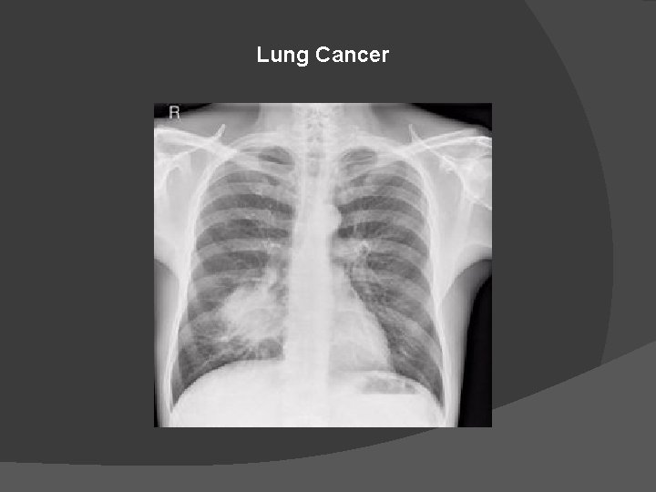 Lung Cancer 