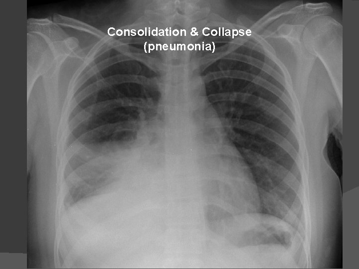 Consolidation & Collapse (pneumonia) 