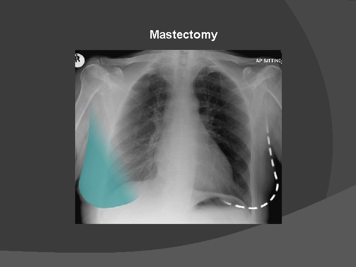 Mastectomy 