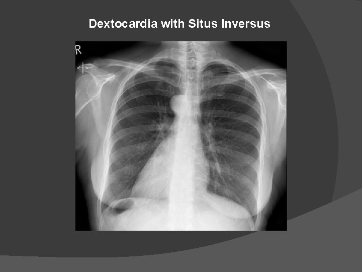 Dextocardia with Situs Inversus 