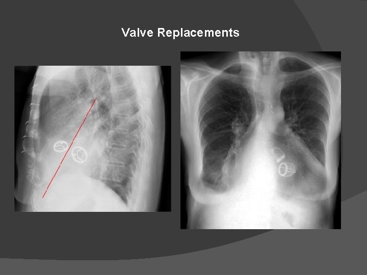 Valve Replacements 