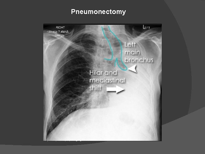 Pneumonectomy 