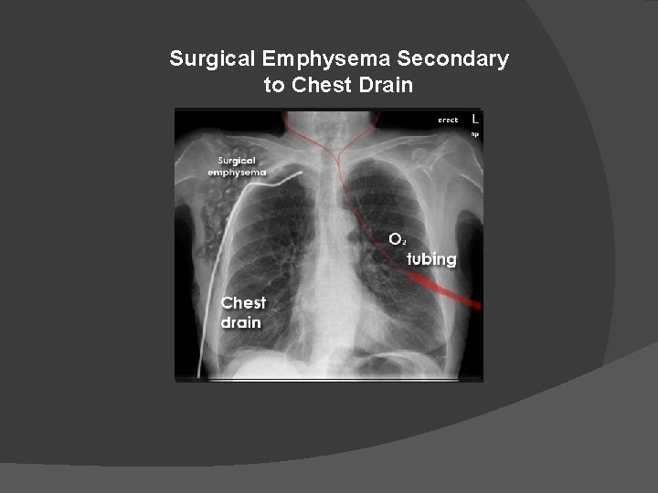 Surgical Emphysema Secondary to Chest Drain 