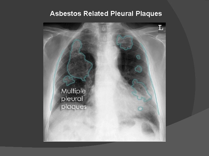 Asbestos Related Pleural Plaques 