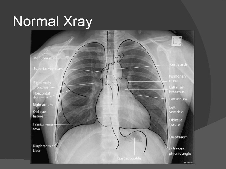 Normal Xray 