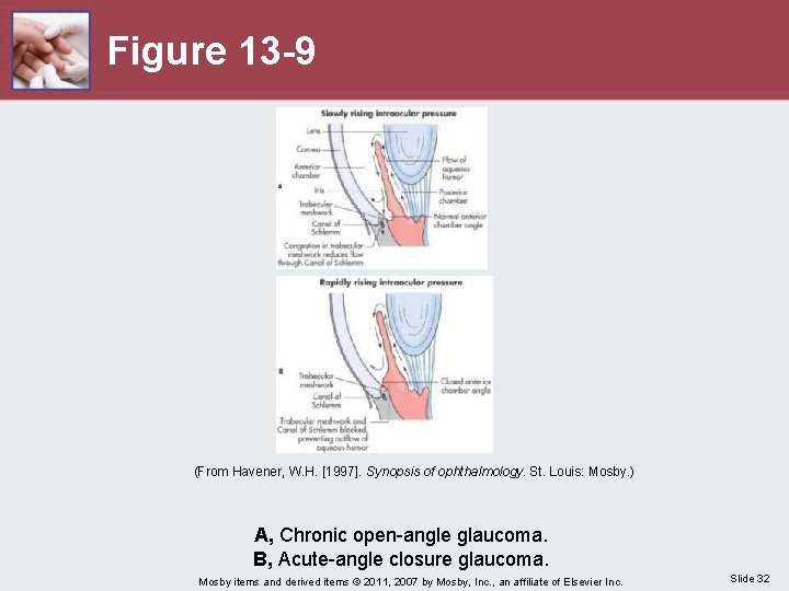 Figure 13 -9 (From Havener, W. H. [1997]. Synopsis of ophthalmology. St. Louis: Mosby.