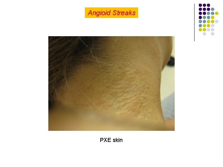 Angioid Streaks PXE skin 