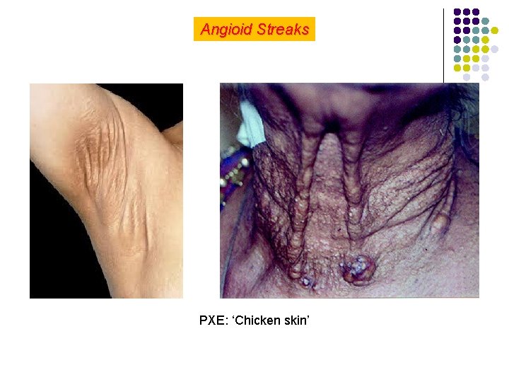 Angioid Streaks PXE: ‘Chicken skin’ 