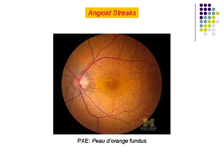 Angioid Streaks PXE: Peau d’orange fundus 