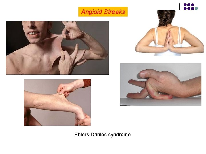 Angioid Streaks Ehlers-Danlos syndrome 