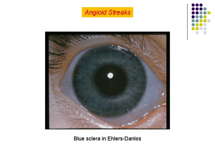 Angioid Streaks Blue sclera in Ehlers-Danlos 