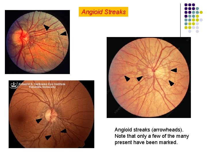 Angioid Streaks Angioid streaks (arrowheads). Note that only a few of the many present