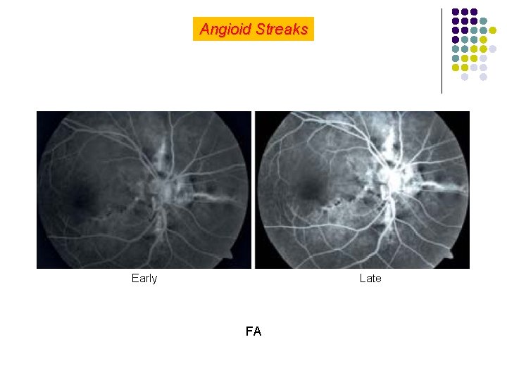 Angioid Streaks Early Late FA 