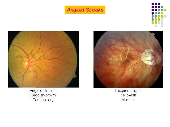 Angioid Streaks Angioid streaks: ‘Reddish-brown’ ‘Peripapillary’ Lacquer cracks: ‘Yellowish’ ‘Macular’ 