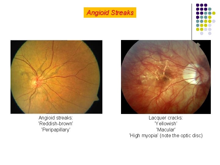 Angioid Streaks Angioid streaks: ‘Reddish-brown’ ‘Peripapillary’ Lacquer cracks: ‘Yellowish’ ‘Macular’ ‘High myopia’ (note the