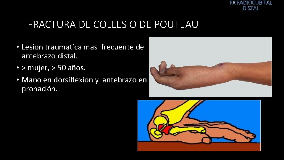 FX RADIOCUBITAL DISTAL FRACTURA DE COLLES O DE POUTEAU • Lesión traumatica mas frecuente