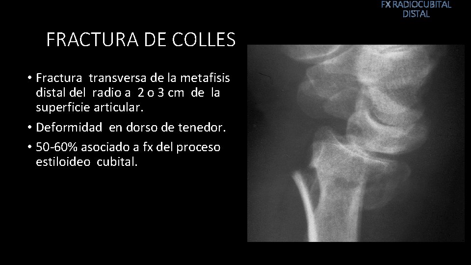 FX RADIOCUBITAL DISTAL FRACTURA DE COLLES • Fractura transversa de la metafisis distal del